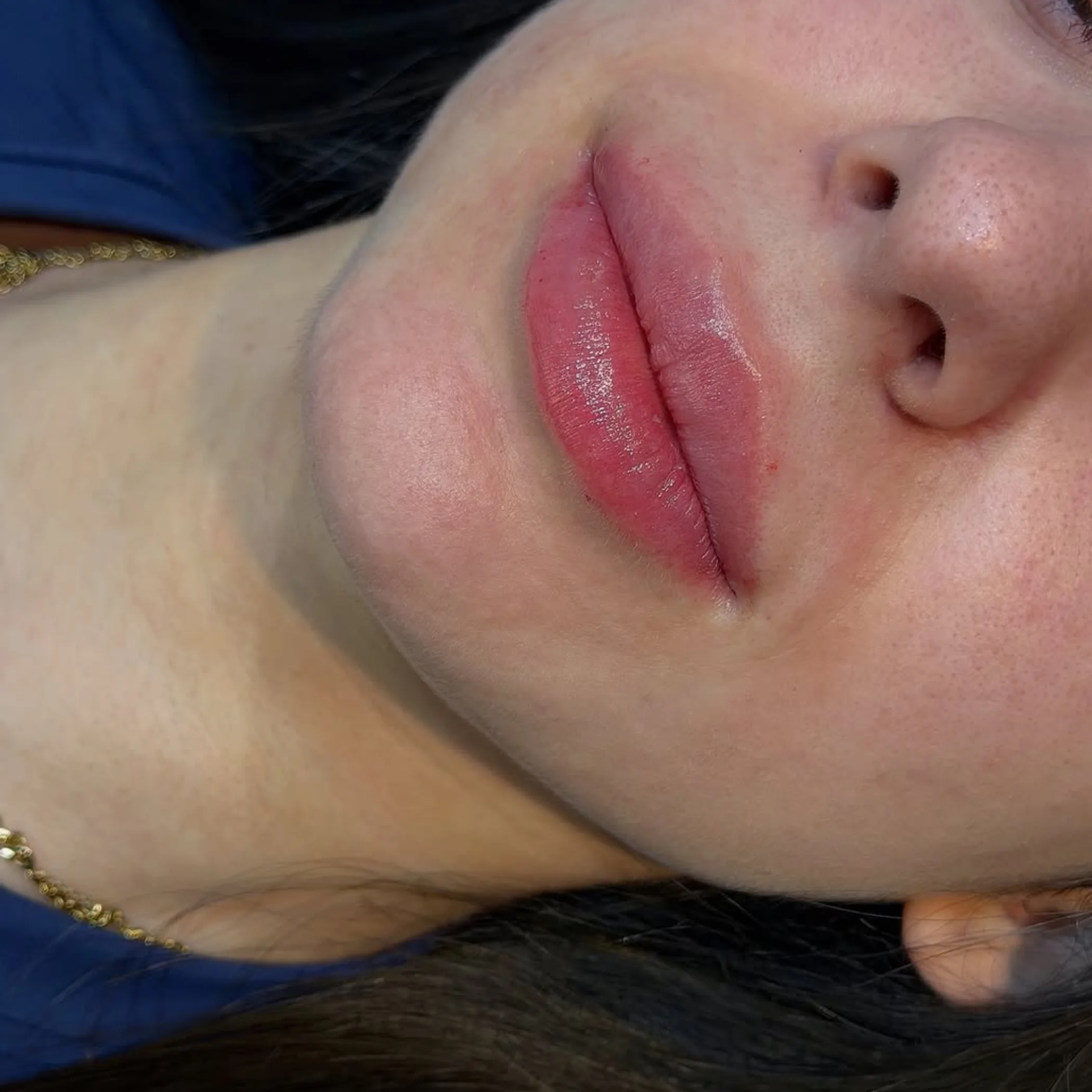 lips relevant to lip filler