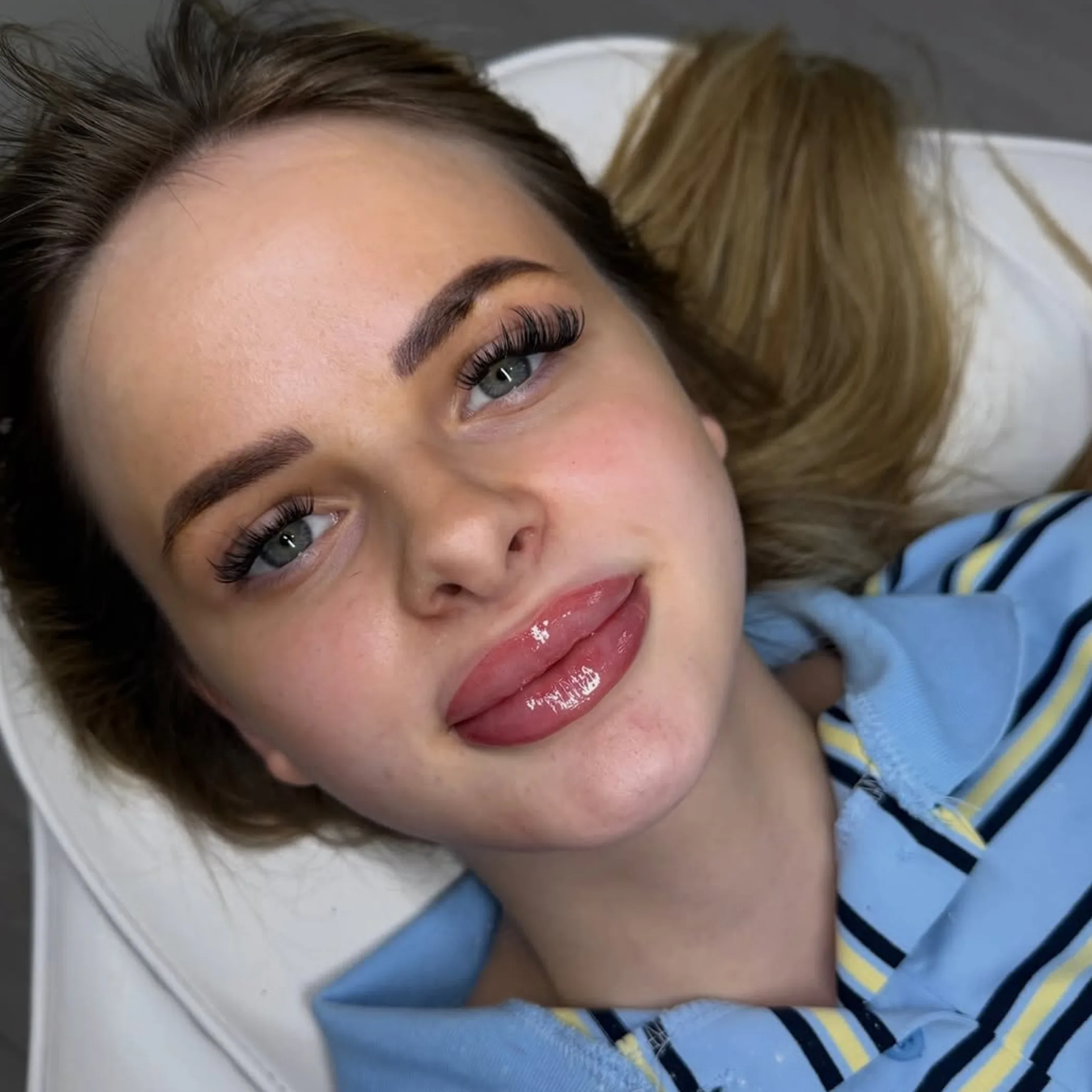 treated lips after cosmetic procedures