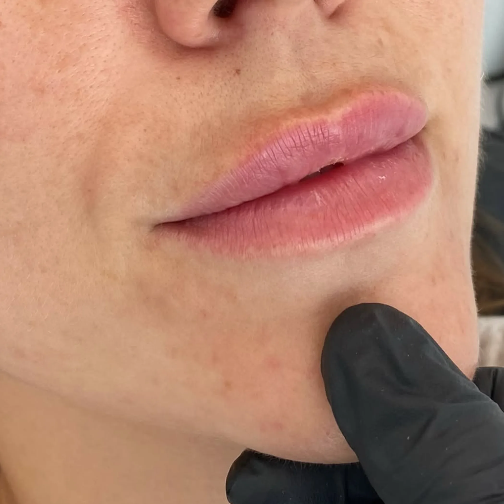 lips during aesthetic treatment